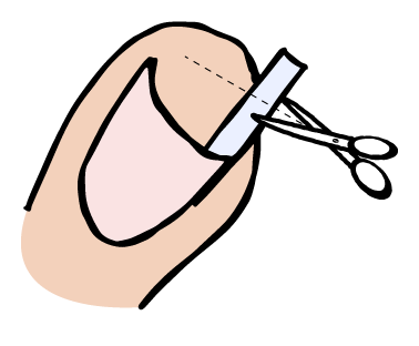 Nageltrångskit